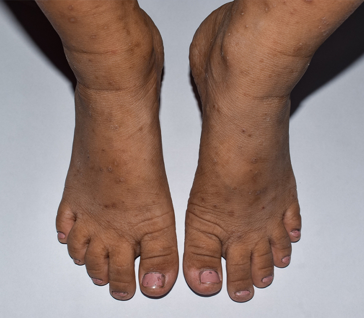 Charcot Foot