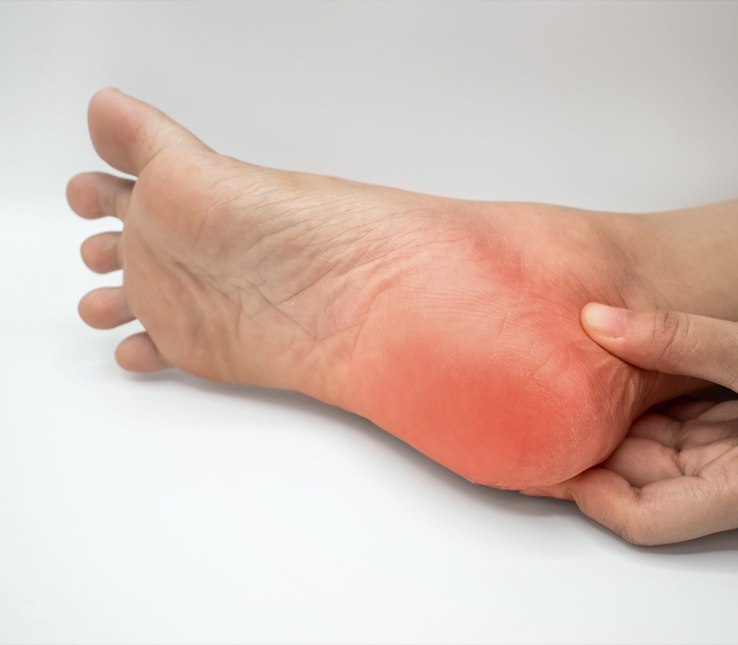 Heel Pain