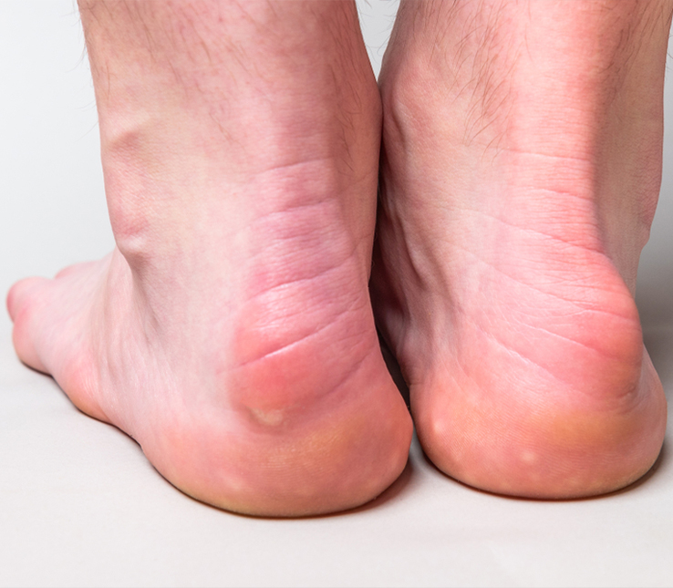 Pump Bump syndrome Haglunds Disease