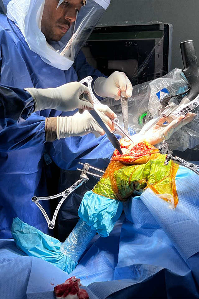 Robotic knee surgery by Dr.Santhosh C Reddy