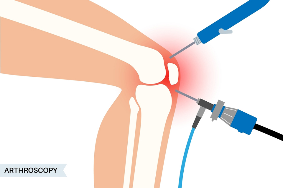 Arthroscopy Knee Surgery