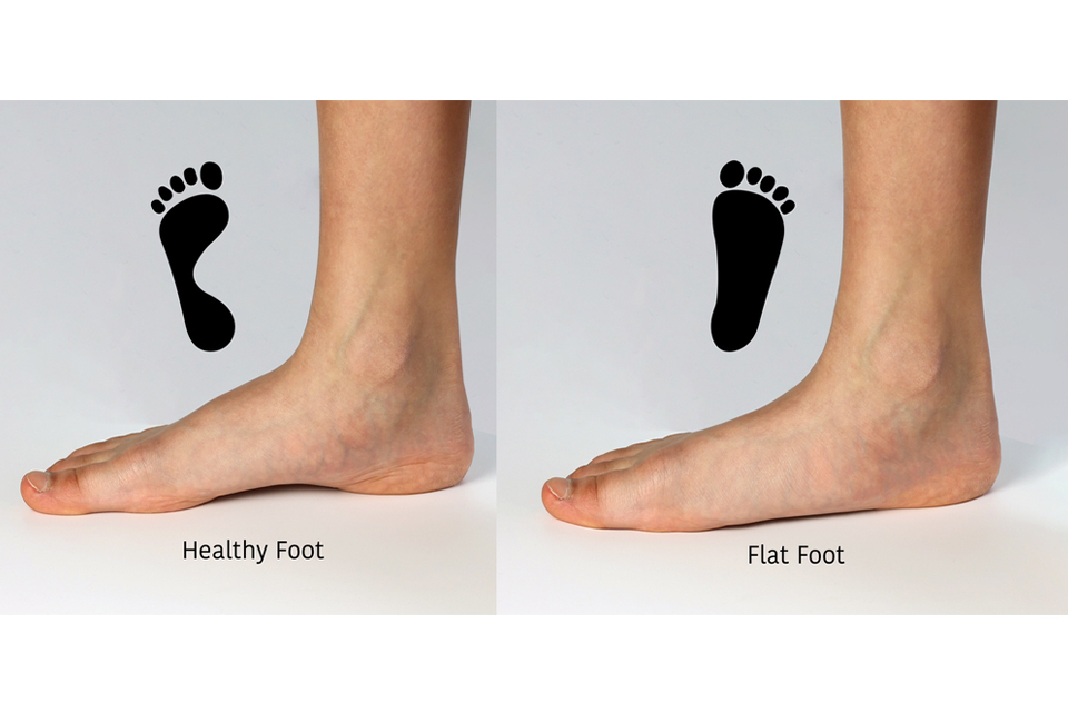 Flat feet and normal feet