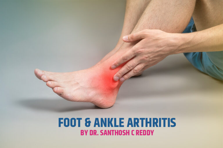 Foot & Ankle Arthritis Early Warning Signs Most People Ignore