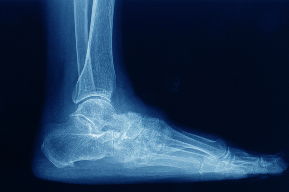 Foot deformity X-Ray